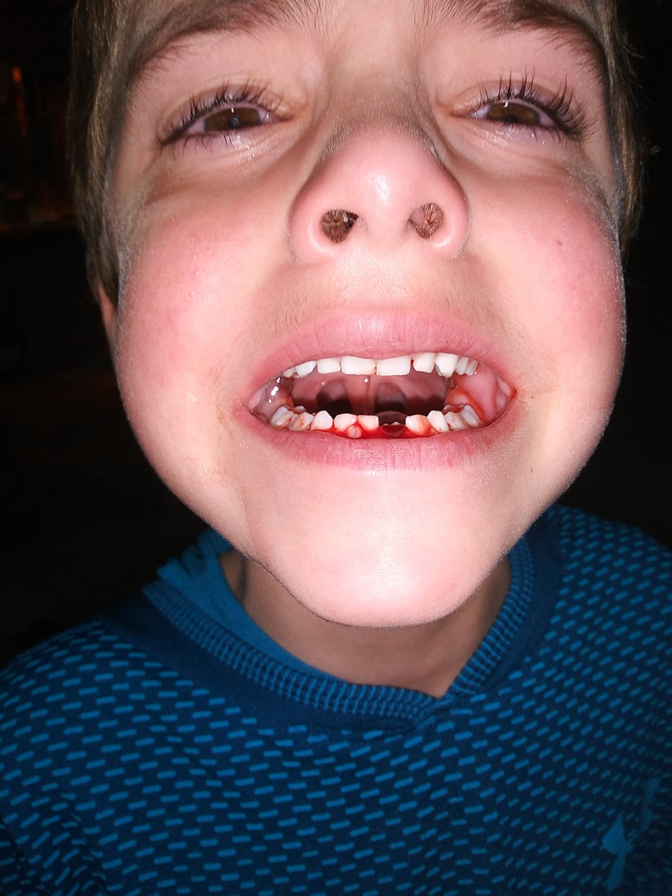 20191218 Victor lost his tooth