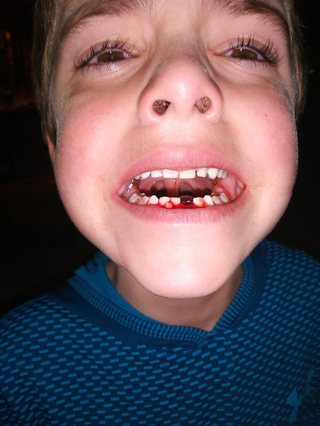 20191218 Victor lost his tooth